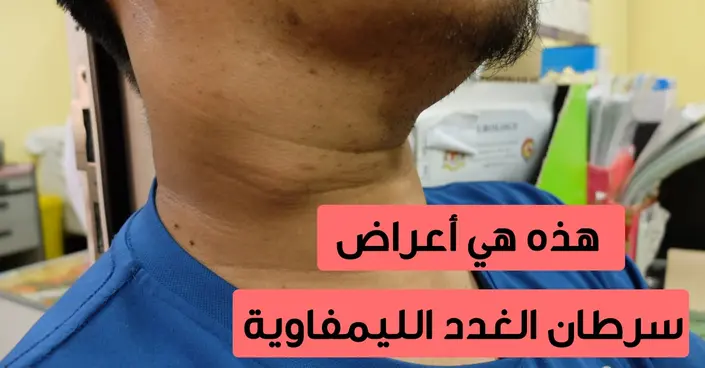 أعراض سرطان الغدد الليمفاوية: علامات مبكرة ومؤشرات هامة يجب أن تعرفها