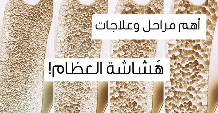 دليلك الشامل: أعراض هشاشة العظام ومراحلها وكيف تتعرف عليها