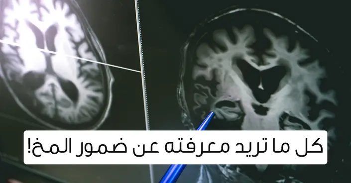 ضمور المخ: دليلك الشامل لفهم أسبابه، أعراضه وخيارات العلاج