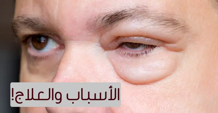 ارتفاع ضغط العين: دليلك الشامل لفهم الأعراض، الأسباب والعلاج