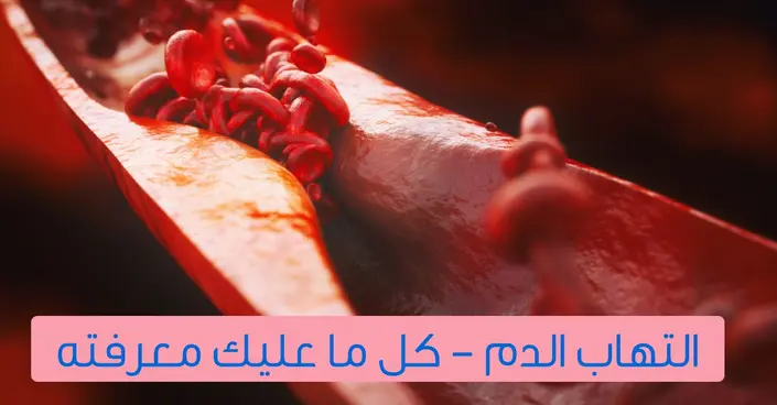التهاب الدم: دليل شامل لفهم الأسباب، الأعراض، والوقاية من هذه الحالة الخطيرة
