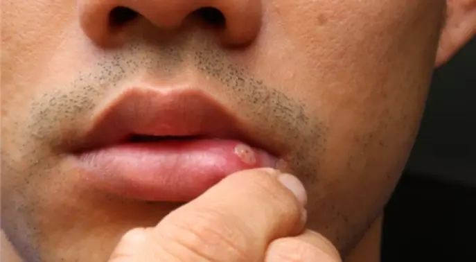 اكتشف 5 حقائق حاسمة عن سرطان الفم: دليل شامل للوقاية والكشف المبكر