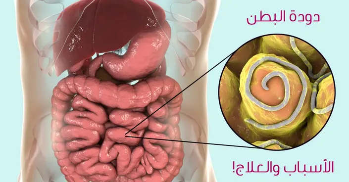 علاج ديدان البطن: دليل شامل للتخلص منها طبيًا وبالأعشاب