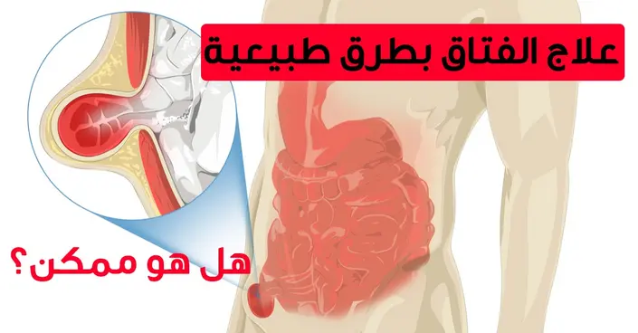 السيطرة على الفتاق بطرق طبيعية: دليل شامل لتخفيف الأعراض وتحسين جودة حياتك