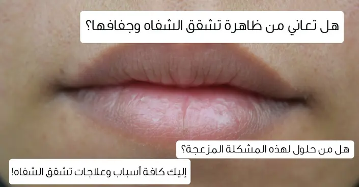 الشفاه المتشققة: دليلك الشامل للأسباب، العلاج، والوقاية لابتسامة صحية