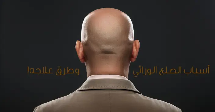 علاج الصلع الوراثي: دليلك الشامل لأحدث الحلول والمعلومات