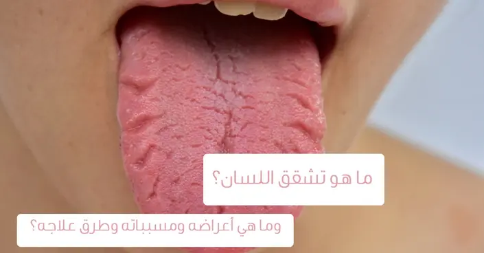 تشقق اللسان: دليل شامل لفهم الأسباب، الأعراض، والعلاج