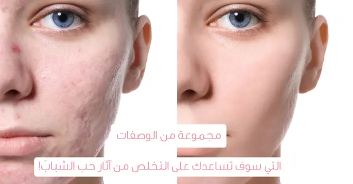 التخلص من ندوب حب الشباب: دليلك الشامل للوصفات الطبيعية والعناية بالبشرة