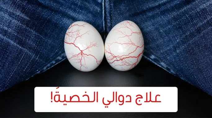 دليلك الشامل لـ علاج دوالي الخصية: من الجراحة إلى الحلول الطبيعية