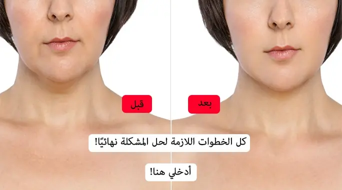 شعر الذقن لدى المرأة: دليل شامل للأسباب والعلاج الفعال