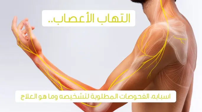 دليل شامل لالتهاب الأعصاب: فهم الأعراض، الأسباب، وخيارات العلاج الفعالة