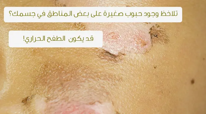 الطفح الحراري: دليلك الشامل للتعرف على الأسباب، الأنواع، والوقاية منه