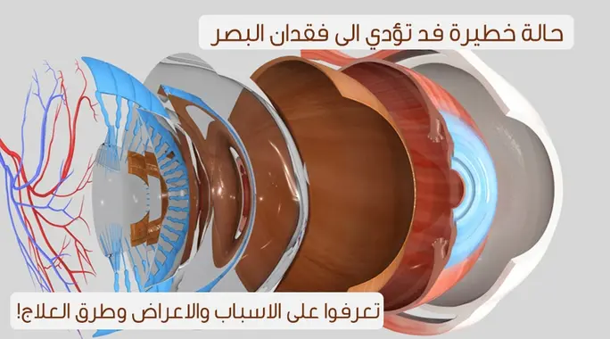 انفصال الشبكية: دليلك الشامل لمرض فقدان البصر وأساليب علاجه الفعالة