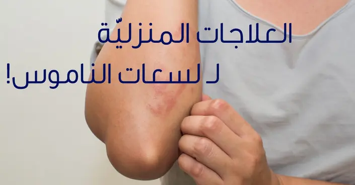 وداعًا للحكة المزعجة: 7 طرق فعالة لـ علاج قرص الناموس طبيعيًا