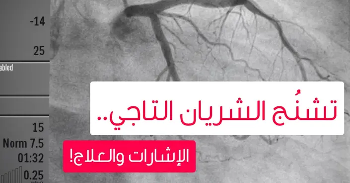تشنج الشريان التاجي: دليلك الشامل للأسباب، الأعراض، والوقاية