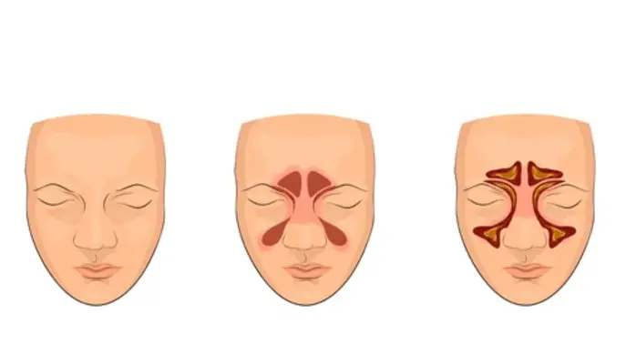 Effective Tips for Sinusitis Relief: Your Comprehensive Guide to Managing Sinus Infections