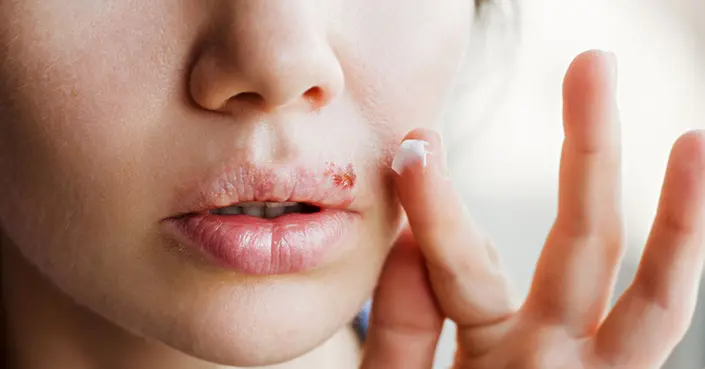 قرحة البرد: دليلك الشامل لعلاجها سريعًا والتخفيف من أعراضها