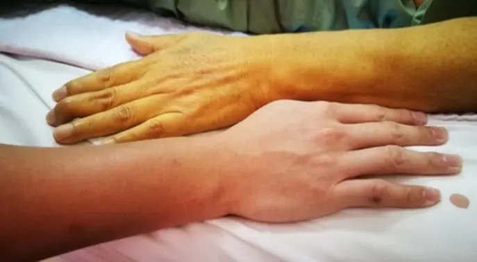 مرض الصفراء (اليرقان): علامات تحذيرية تكشف أمراضًا كامنة وأسبابها وطرق علاجها
