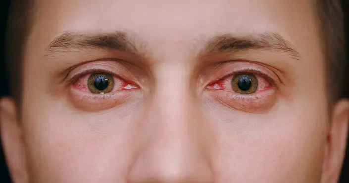 الرمد الربيعي: دليلك الشامل لتخفيف حساسية العين الموسمية