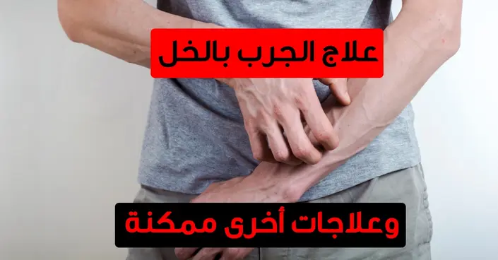 اكتشف قوة الخل: علاج الجرب بالخل وعلاجات منزلية أخرى تخفف الحكة بفعالية