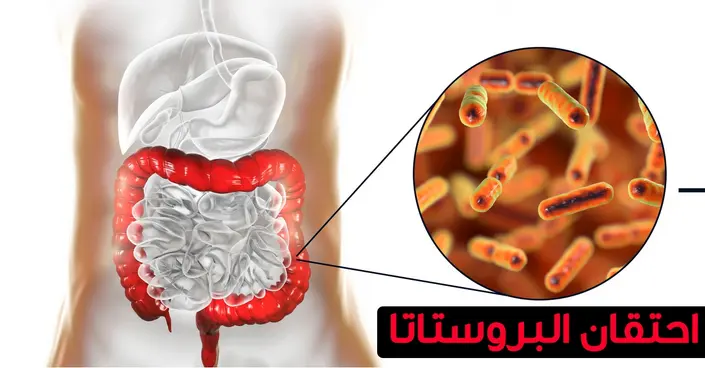 احتقان البروستاتا: دليلك الشامل للأسباب، الأعراض، وطرق العلاج والوقاية