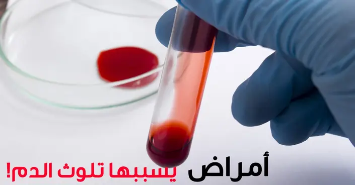 تلوث الدم: أمراض خطيرة يسببها وكيف تحمي نفسك منها