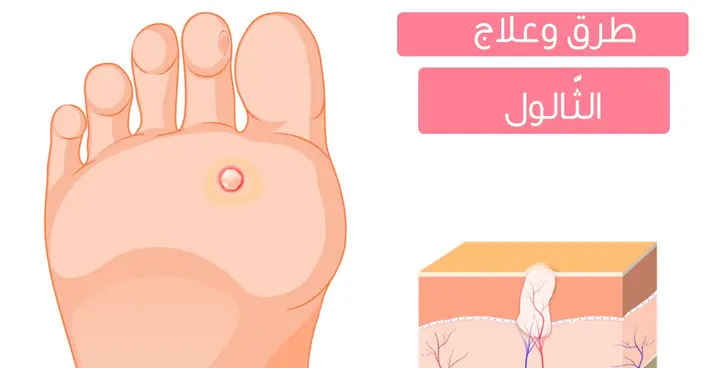 دليلك الشامل: استكشف علاجات الثالول الممكنة للتخلص منها بفعالية