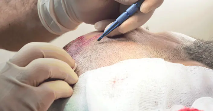 دليل شامل: تعليمات زراعة الشعر قبل وبعد العملية لنتائج مثالية