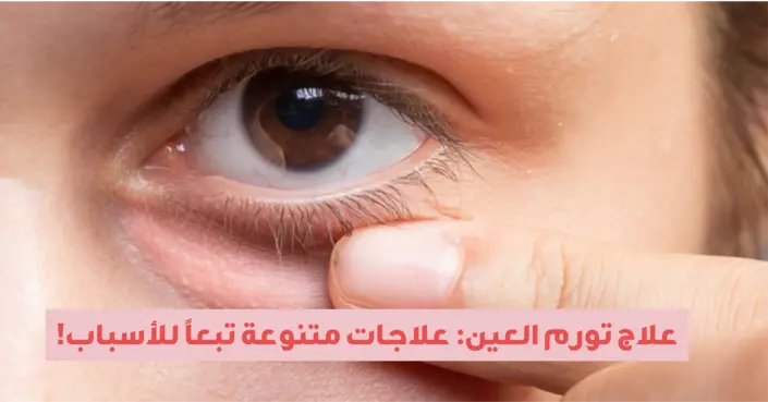 علاج تورم العين: دليلك الشامل لأسباب الانتفاخ وطرق التخلص منه