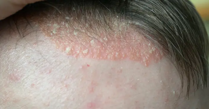 وداعًا لحكة فروة الرأس: دليل شامل لأكزيما الشعر وأساليب علاجها الفعّالة