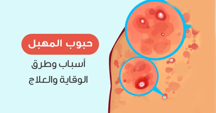 دليل شامل: أسباب حبوب منطقة المهبل، طرق الوقاية والعلاج الفعّالة