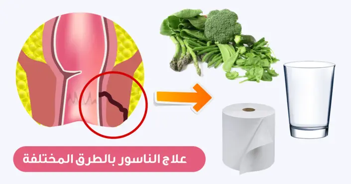 دليلك الشامل: علاج الناسور بالطرق المختلفة والوقاية منه