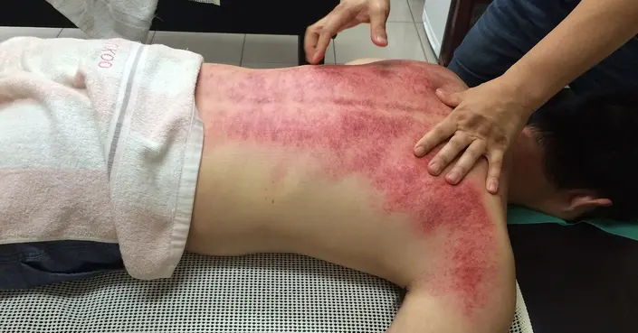 حروق الليزر: دليلك الشامل للأعراض، الأسباب، العلاج، والوقاية الفعالة