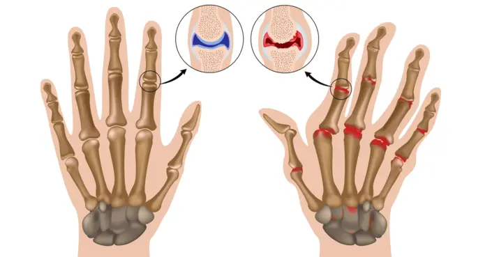 أعراض الروماتيزم: دليلك الشامل لفهم العلامات المبكرة والعلاج