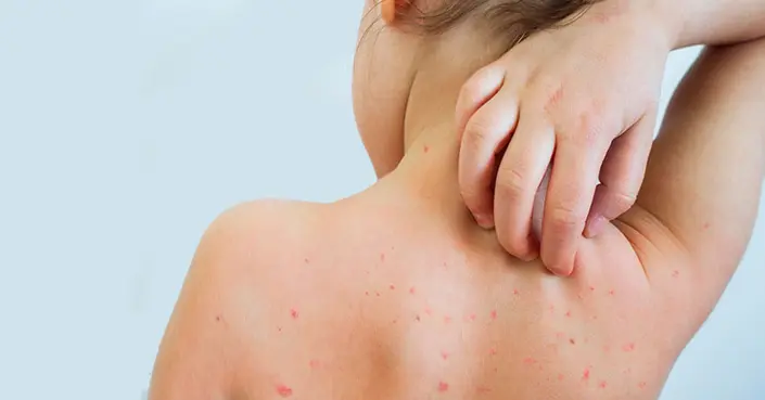 طرق الوقاية من الحصبة: دليلك الشامل لحماية عائلتك وصحتك