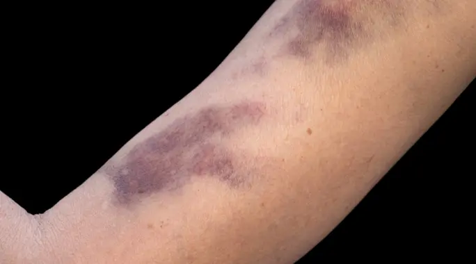 لماذا تظهر التجمعات الدموية تحت الجلد؟ الأسباب، الأعراض، والعلاج المنزلي الفعال