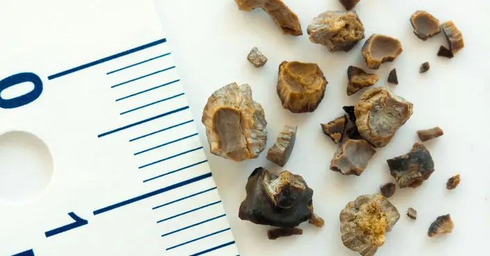 طرق تفتيت حصى الكلى: دليلك الشامل للعلاج والوقاية