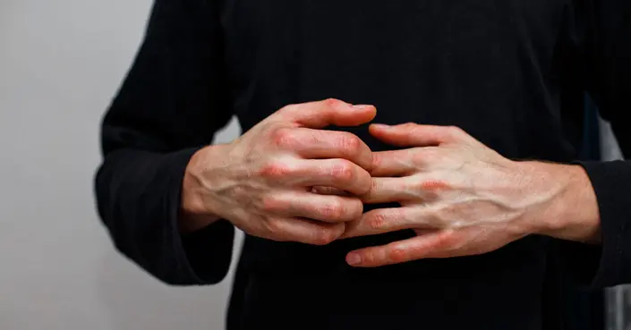 علاج الأكزيما بالأعشاب: دليل طبيعي لتهدئة البشرة واستعادة راحتها