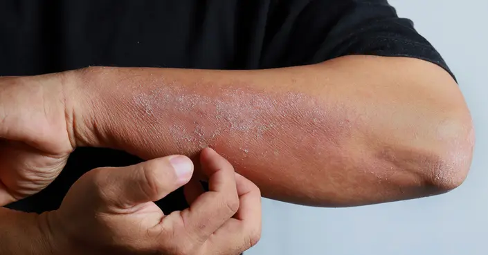 العسل لعلاج الأكزيما: هل هو الحل الطبيعي الذي تبحث عنه؟