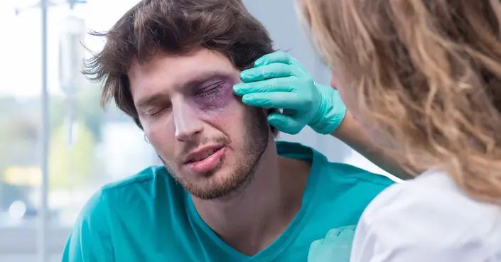 علاج كدمات العين: دليلك الشامل للتخلص من العين السوداء بسرعة وفعالية