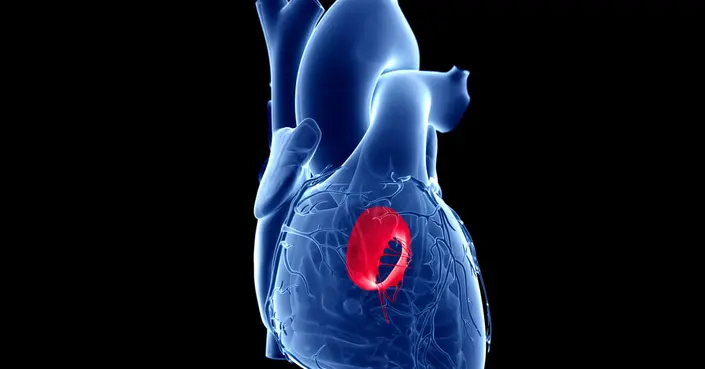 ارتجاع الصمام الميترالي: دليل شامل لفهم الأسباب، الأعراض، وطرق العلاج