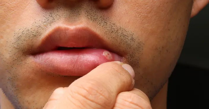 ثآليل الفم: دليل الخبراء الشامل لتعرفها، تعالجها، وتحمي نفسك منها