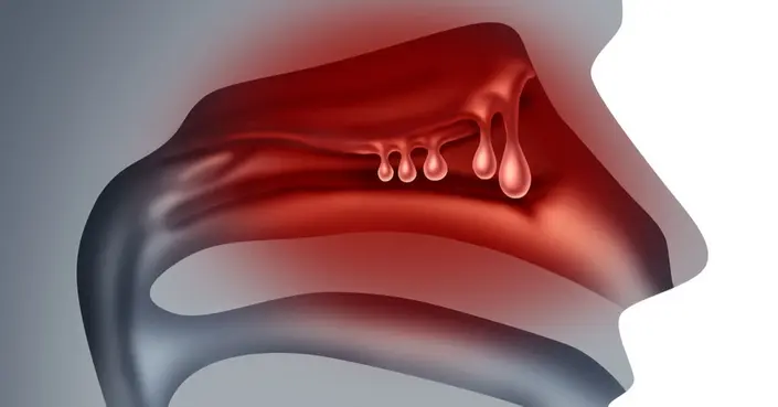 علاج لحمية الأنف: دليلك الشامل لطرق مختلفة لاستعادة التنفس الطبيعي
