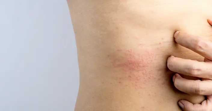 لماذا تظهر حبوب حمراء في البطن؟ الأسباب، العلاج والوقاية