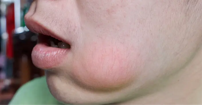 أسباب انتفاخ الوجه عند الأطفال والكبار: دليل شامل لأبرز المسببات والعلاجات