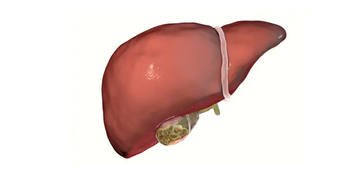 علاج حصوة المرارة بالتفاح: هل هو حقيقة أم خرافة؟ وماذا عن العلاجات الطبيعية الأخرى؟