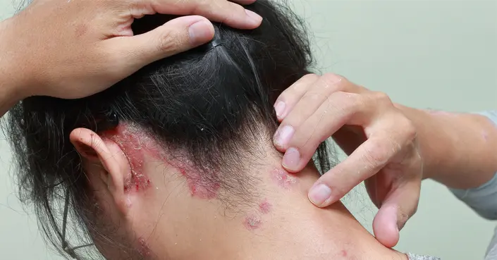 ماذا تسبب بكتيريا وفطريات فروة الرأس؟ دليلك الشامل لصحة فروة الرأس