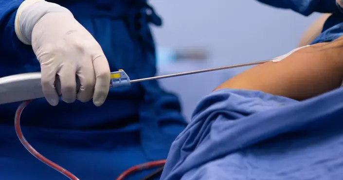 مخاطر عملية شفط الدهون: دليلك الشامل لتجنب المضاعفات