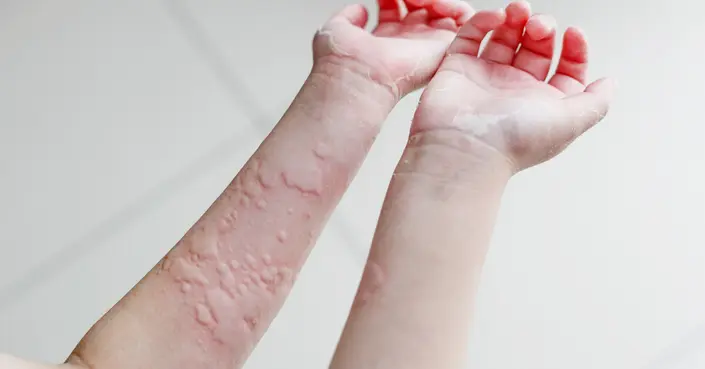 الحساسية من الماء: دليل شامل لأعراضها، أسبابها، وطرق علاجها
