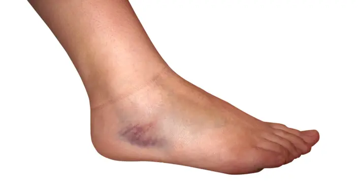 كدمات القدم: دليلك الشامل للأسباب، الأعراض، والعلاج الفعال